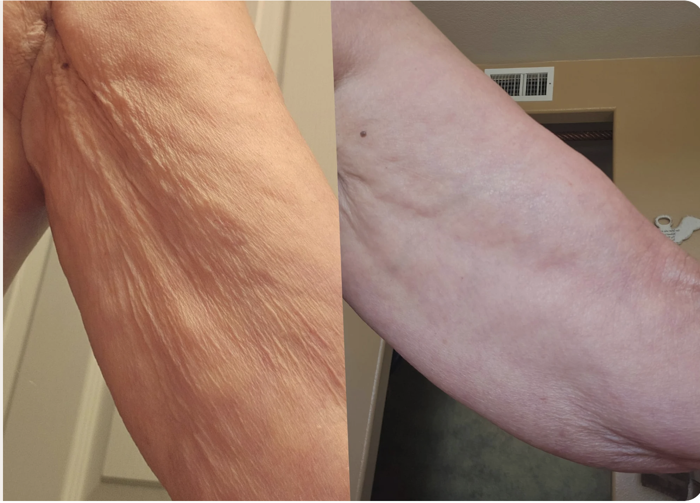 Verified customer before and after using Crepey Skin Repair Cream