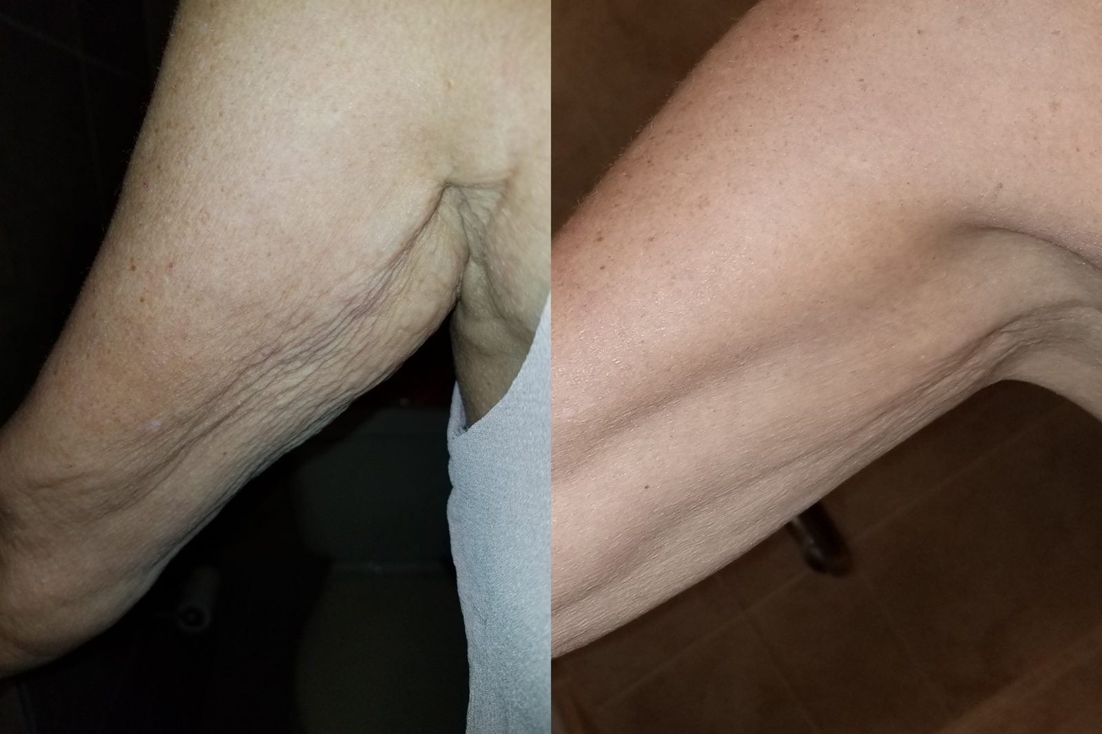 Verified customer before and after using Crepey Skin Repair Cream